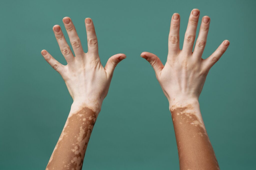 vitiligo