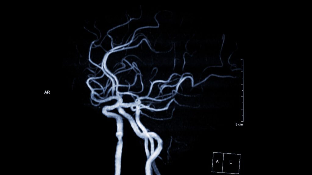 cirurgia de aneurisma