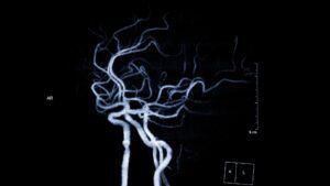 cirurgia de aneurisma